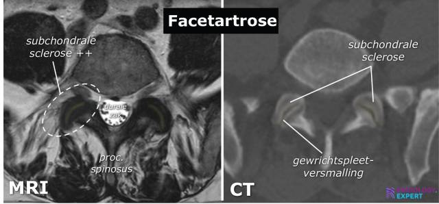 MRI lumbale wervelkolom